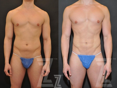 Liposuction Before & After Gallery - Patient 132893823 - Image 1