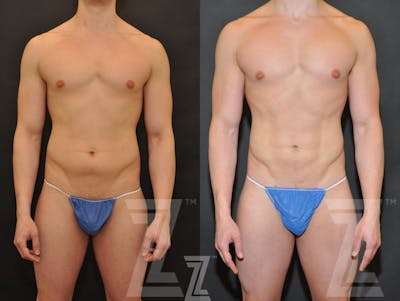 Austin Liposuction Before & After Gallery - Patient 132893823 - Image 1 - The Piazza Center