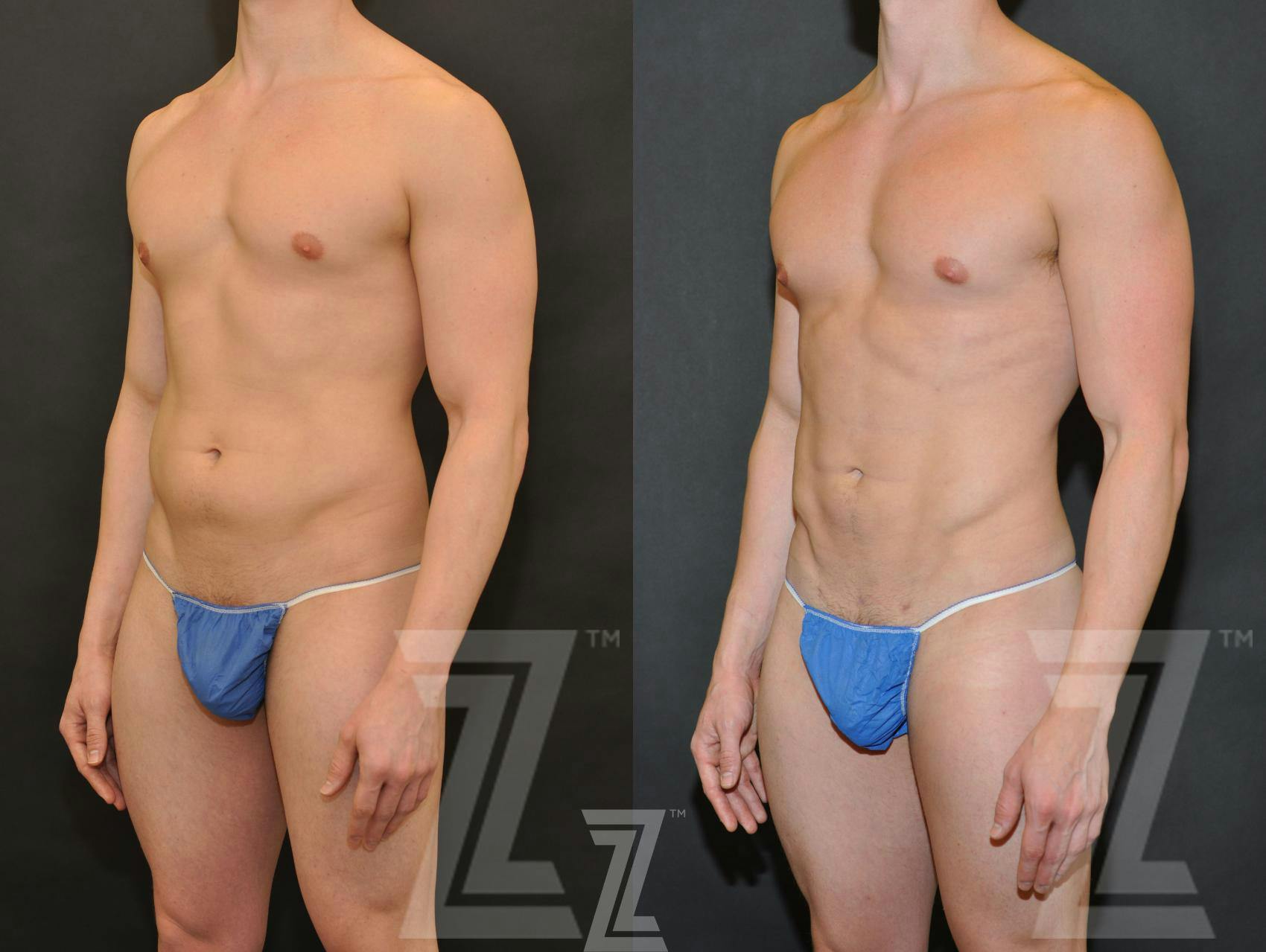 Liposuction Before & After Gallery - Patient 132893823 - Image 2