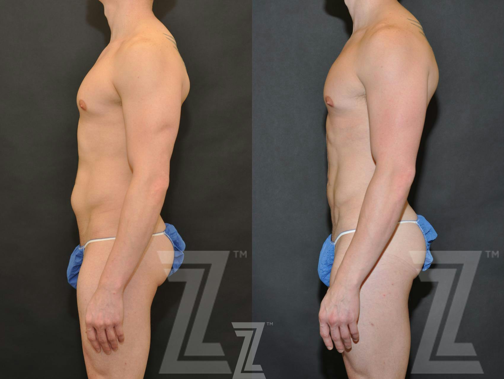 Liposuction Before & After Gallery - Patient 132893823 - Image 3