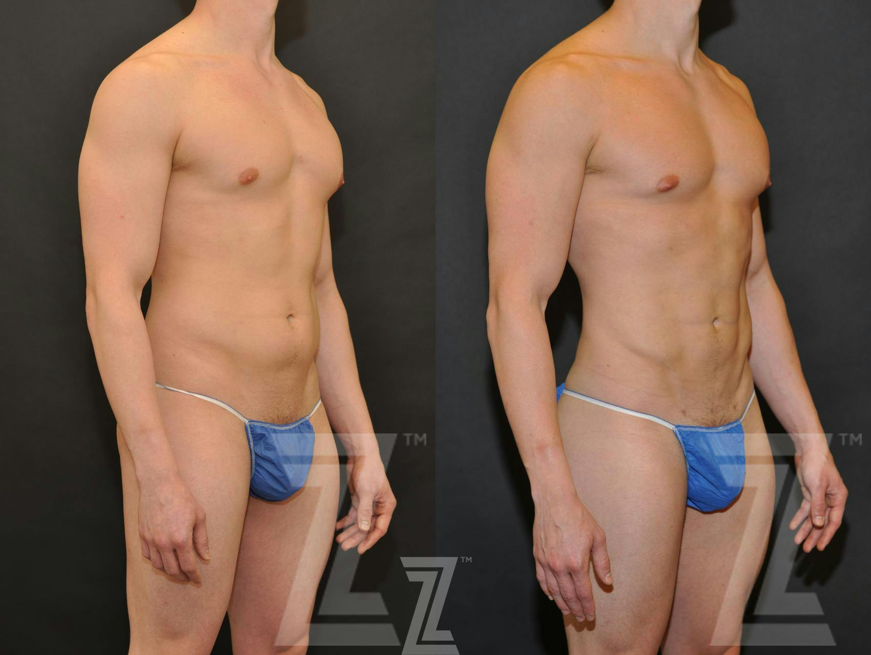 Liposuction Before & After Gallery - Patient 132893823 - Image 4