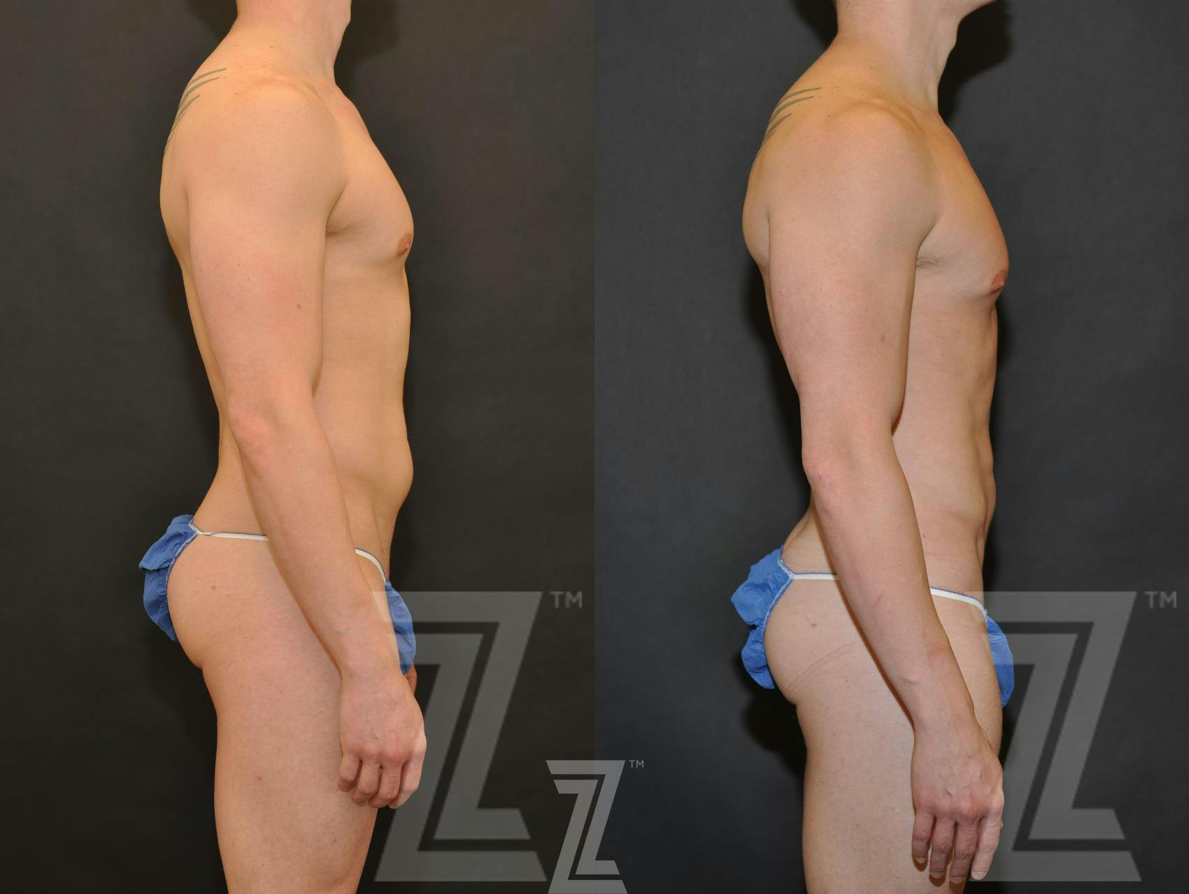 Liposuction Before & After Gallery - Patient 132893823 - Image 5