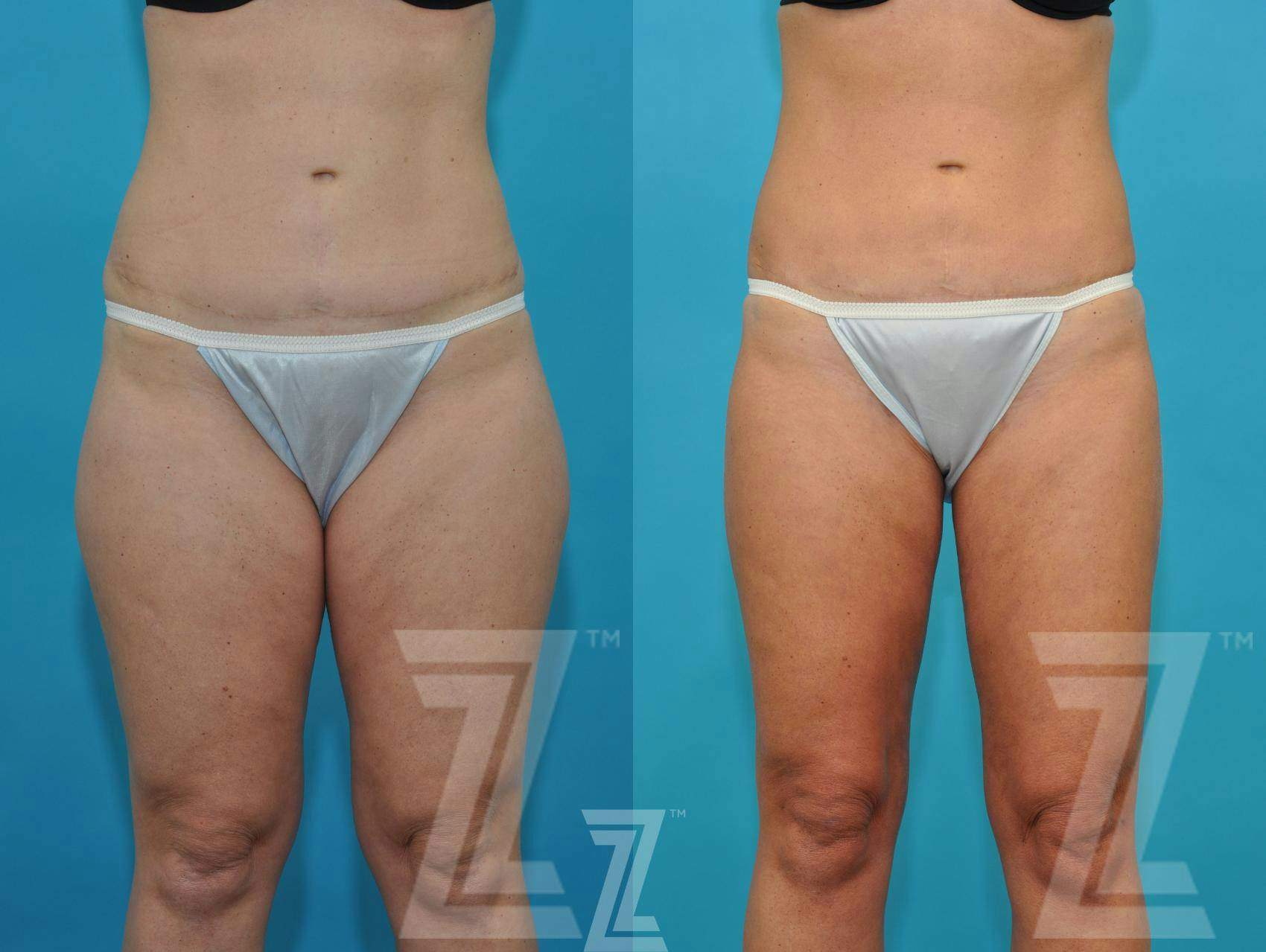Liposuction Before & After Gallery - Patient 132895980 - Image 1