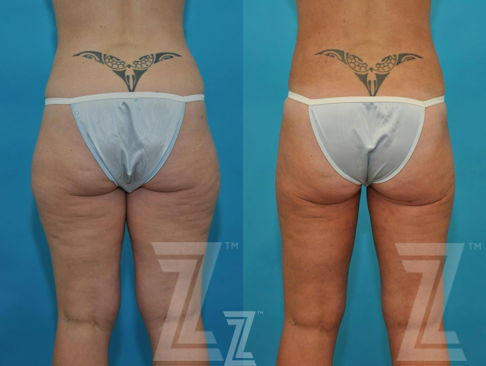 Liposuction Before & After Gallery - Patient 132895980 - Image 2