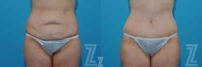 Liposuction Before & After Gallery - Patient 132903278 - Image 1