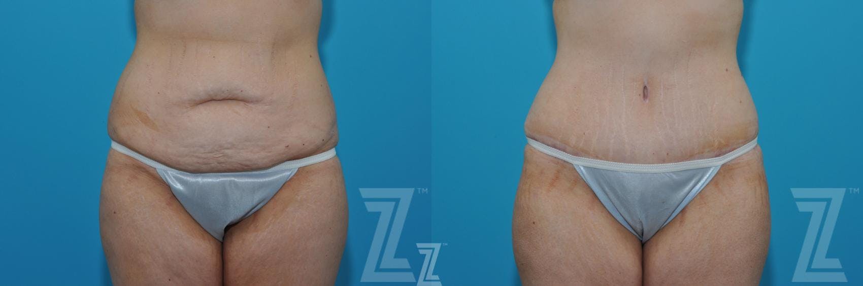 Tummy Tuck Before & After Gallery - Patient 620256 - Image 1