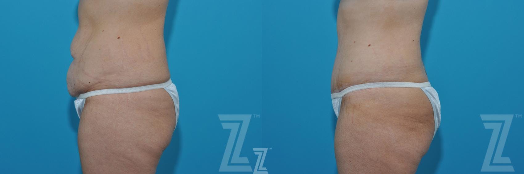 Tummy Tuck Before & After Gallery - Patient 620256 - Image 2