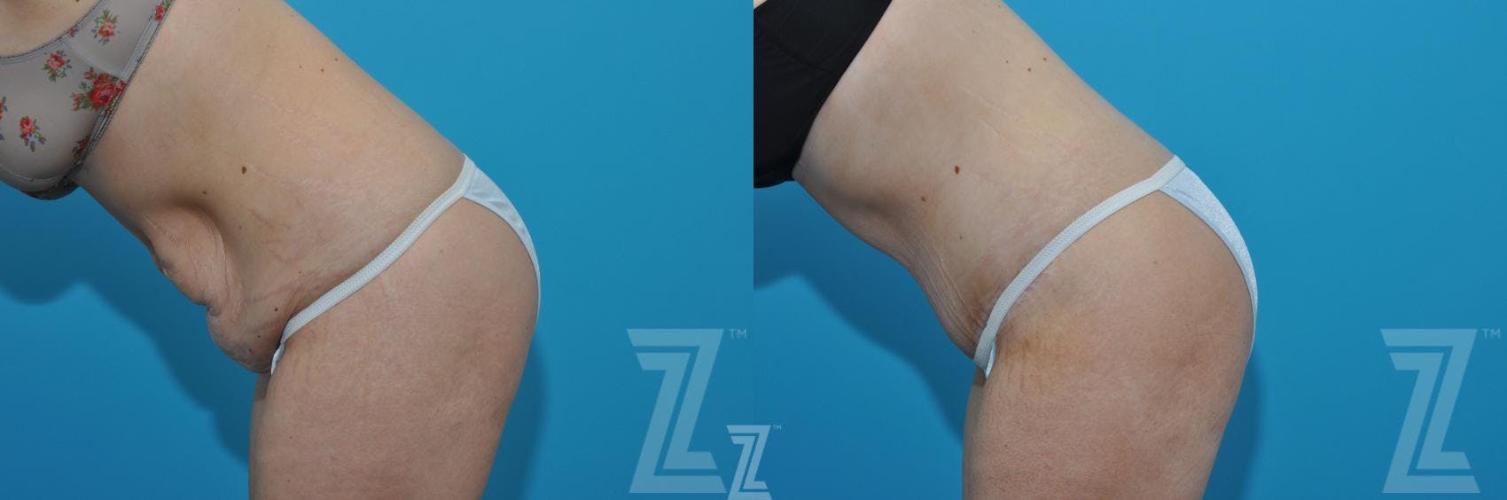 Liposuction Before & After Gallery - Patient 132903278 - Image 3