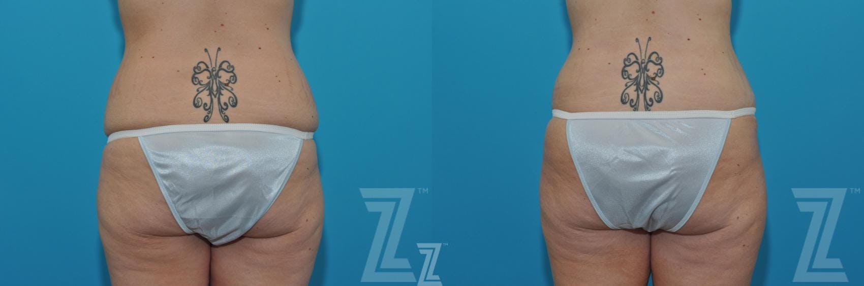 Tummy Tuck Before & After Gallery - Patient 620256 - Image 6