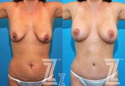 Mommy Makeover Before & After Gallery - Patient 132903294 - Image 1