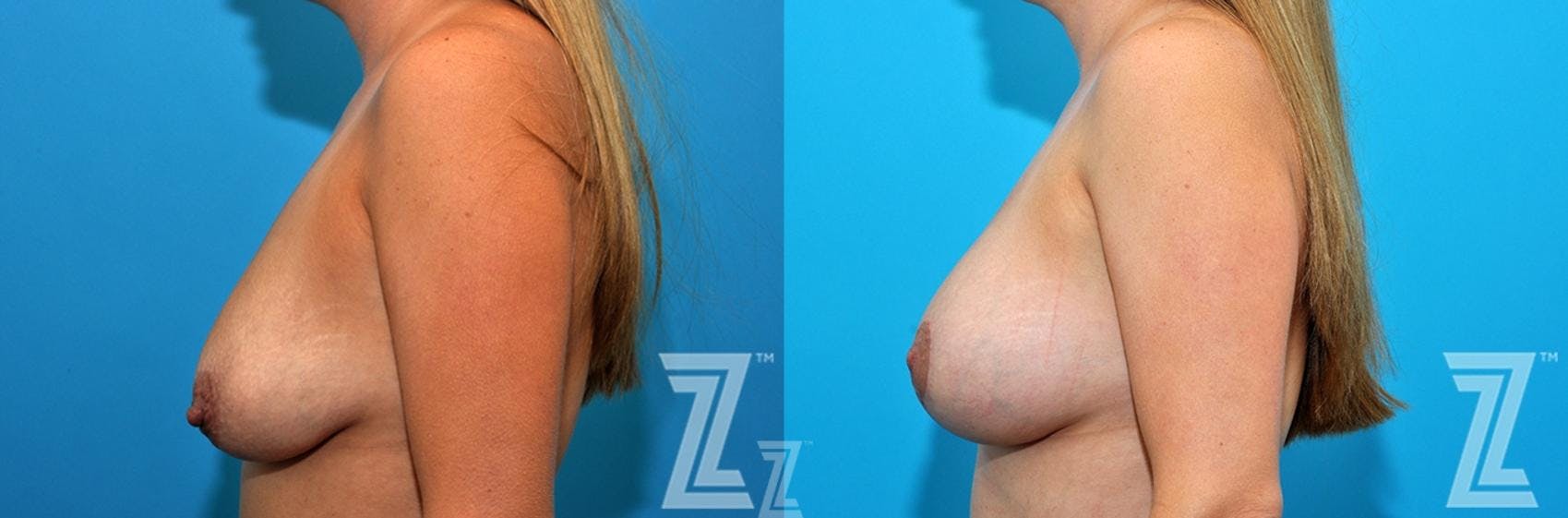 Mommy Makeover Before & After Gallery - Patient 132903294 - Image 9