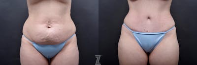 Austin 29-Year-Old Mommy Makeover Before & After by Dr. Rocco Piazza in Austin, Texas - Frontal View of Abdomen - The Piazza Center