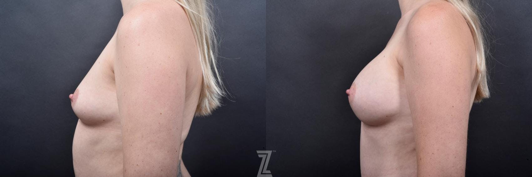 Mommy Makeover Before & After Gallery - Patient 132903295 - Image 9