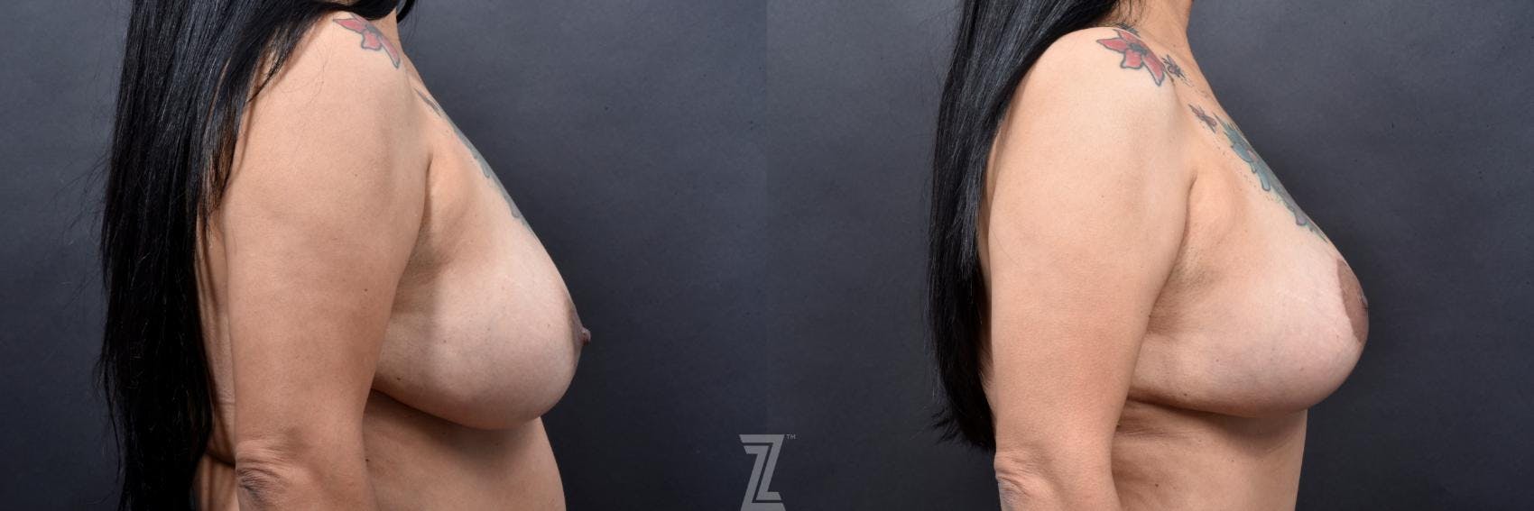 Mommy Makeover Before & After Gallery - Patient 132903300 - Image 5