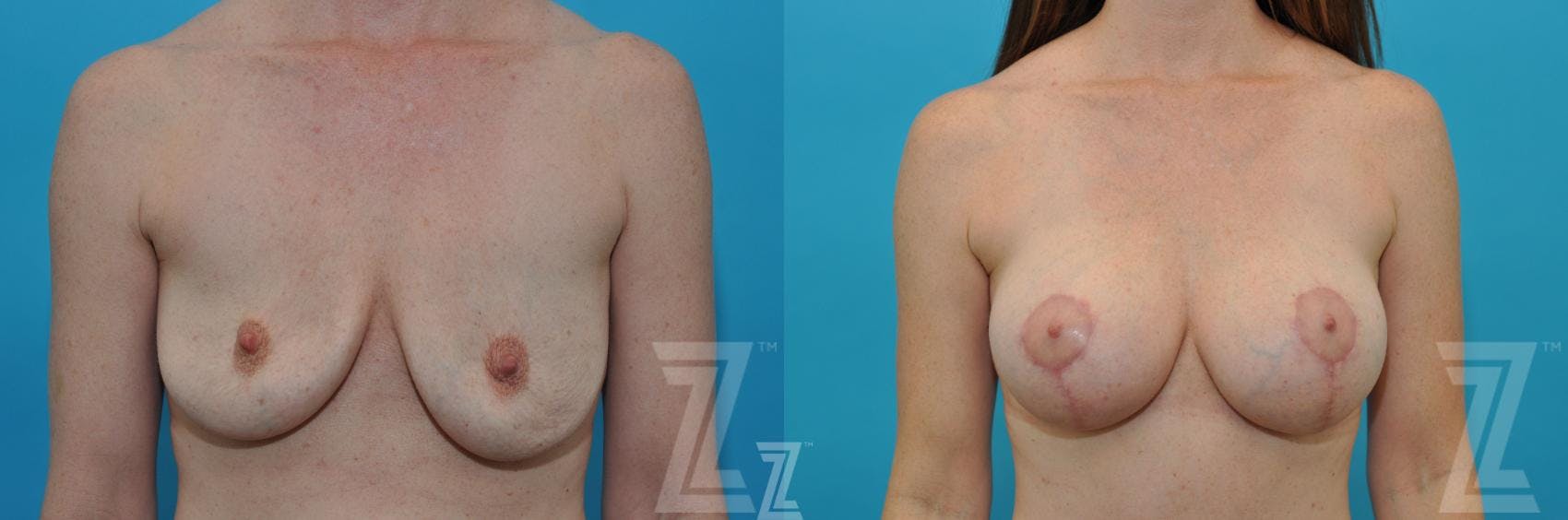 Mommy Makeover Before & After Gallery - Patient 132903301 - Image 1
