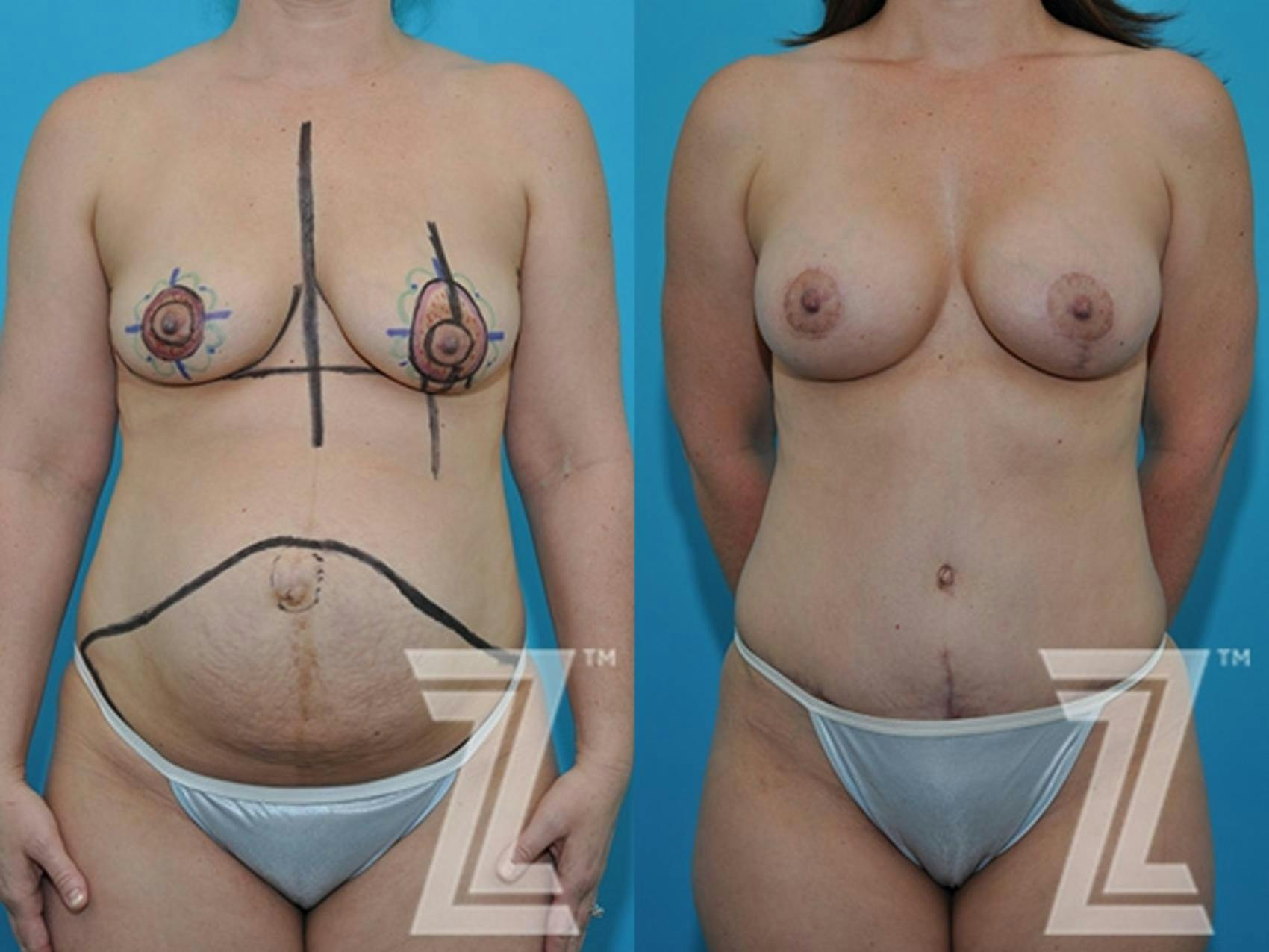 Mommy Makeover Before & After Gallery - Patient 132903304 - Image 1