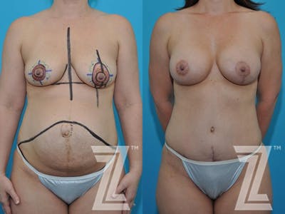 Austin Full Frontal view before & after 3 month post op 39 year old woman mommy make over - The Piazza Center, Austin TX - The Piazza Center