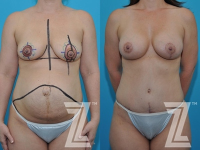 Mommy Makeover Before & After Gallery - Patient 132903304 - Image 1