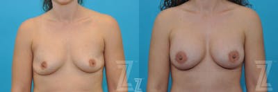 Austin Before & After images frontal breast view of 40-year-old mother of five mommy maker over - Dr. Rocco Piazza, Austin TX - The Piazza Center