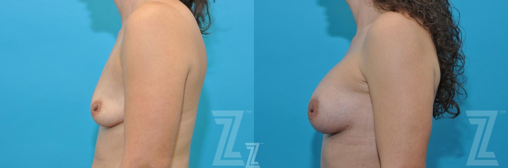 Mommy Makeover Before & After Gallery - Patient 132903362 - Image 3