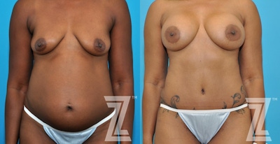 Mommy Makeover Before & After Gallery - Patient 132903365 - Image 1