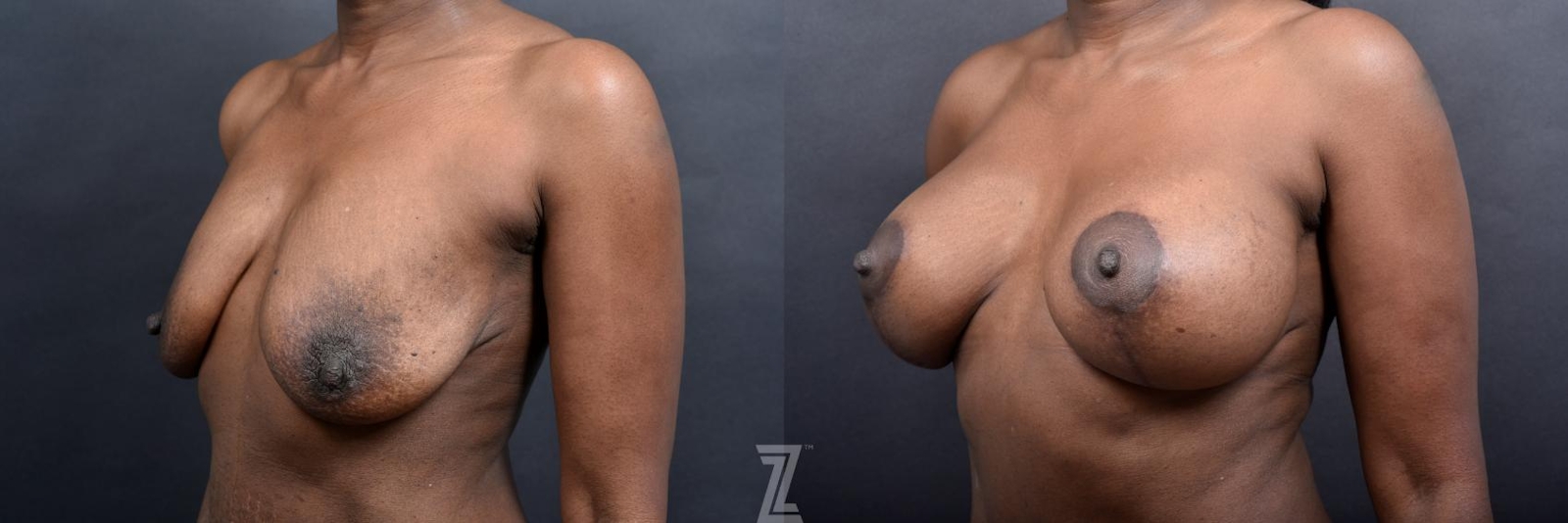 Austin Oblique View of Breasts 1 Year Post-OP Mommy Makeover in Austin, TX by Dr. Rocco Piazza - The Piazza Center