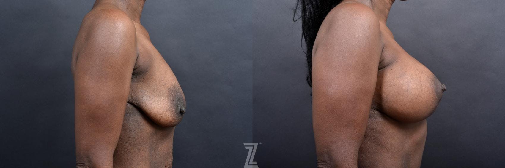 Mommy Makeover Before & After Gallery - Patient 132903367 - Image 6
