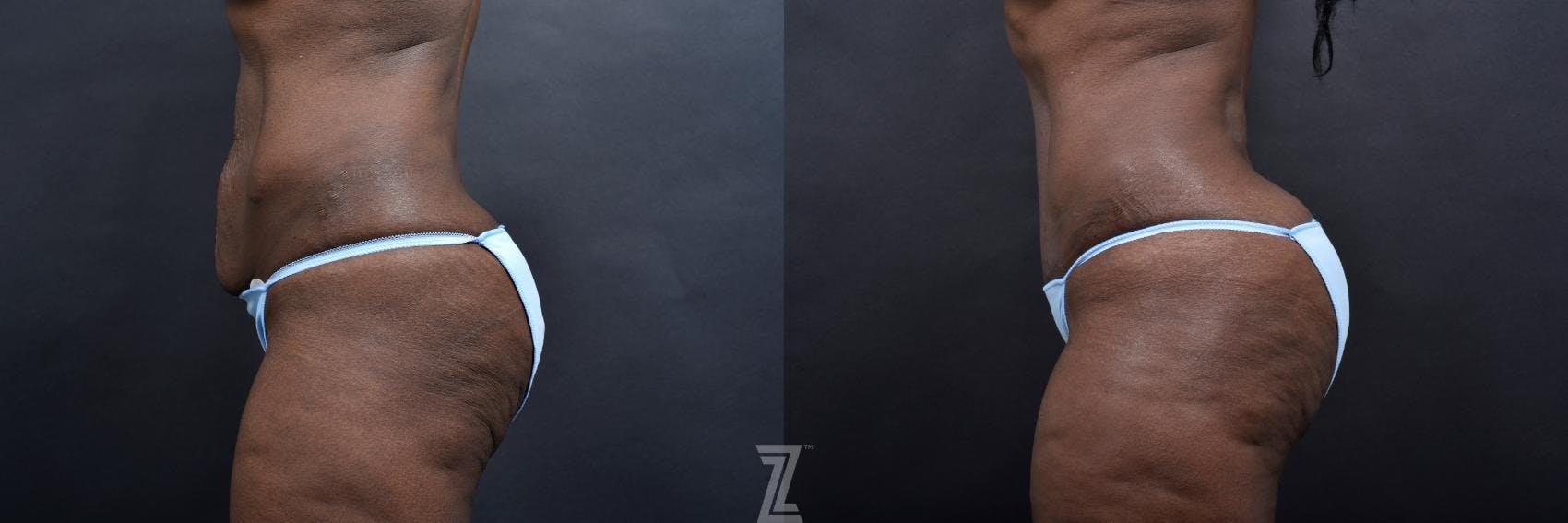 Mommy Makeover Before & After Gallery - Patient 132903367 - Image 8