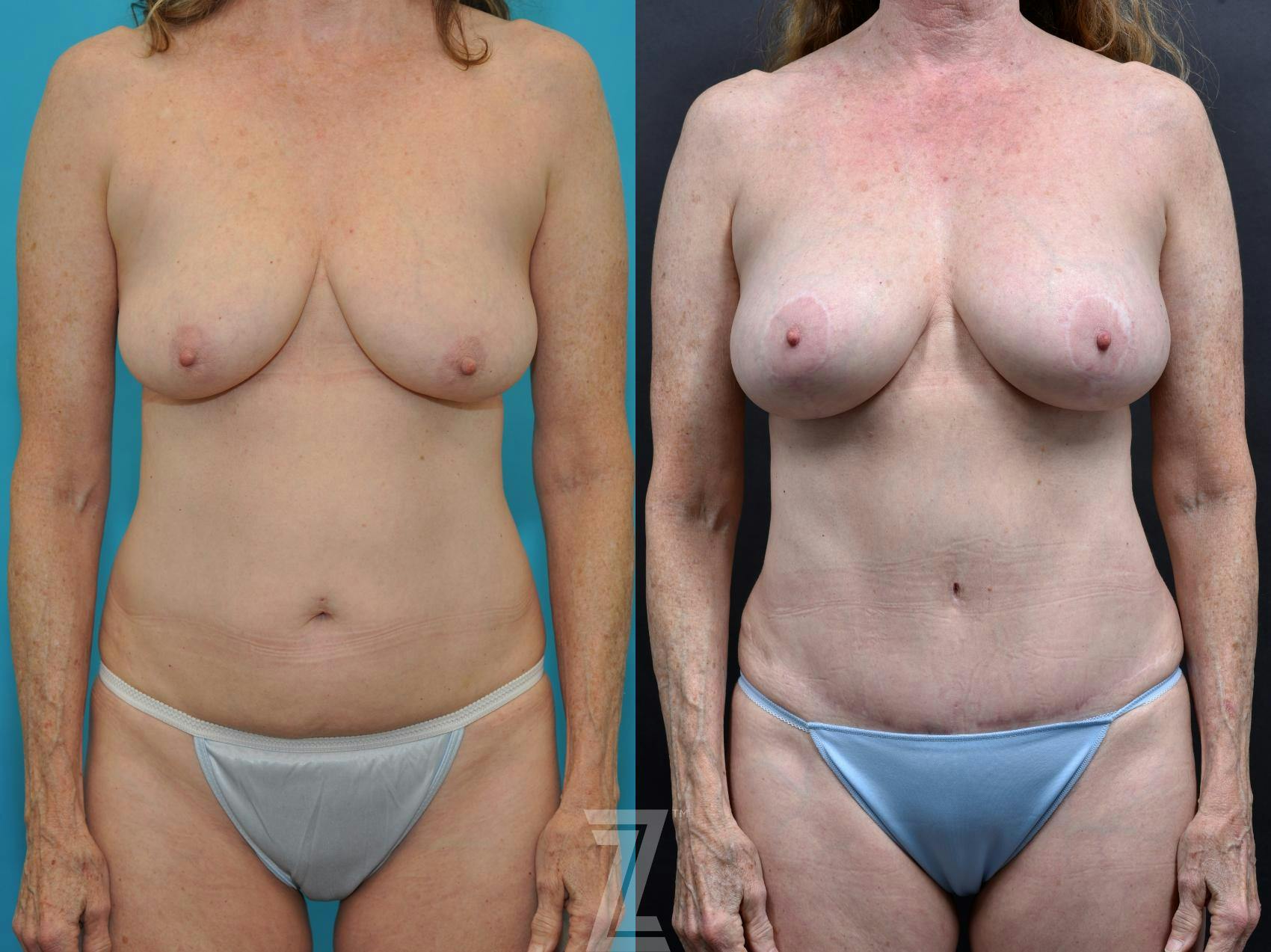 Mommy Makeover Before & After Gallery - Patient 132903373 - Image 1