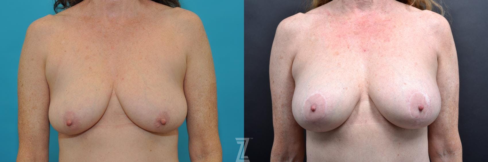 Mommy Makeover Before & After Gallery - Patient 132903373 - Image 2
