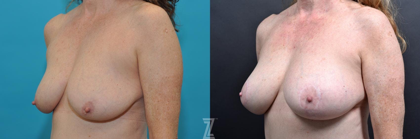 Mommy Makeover Before & After Gallery - Patient 132903373 - Image 3