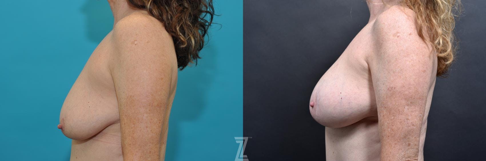 Mommy Makeover Before & After Gallery - Patient 132903373 - Image 4