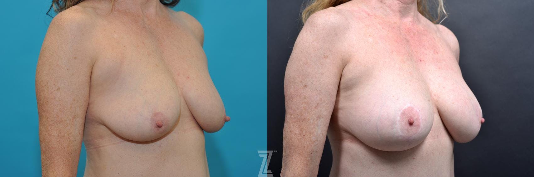 Mommy Makeover Before & After Gallery - Patient 132903373 - Image 5