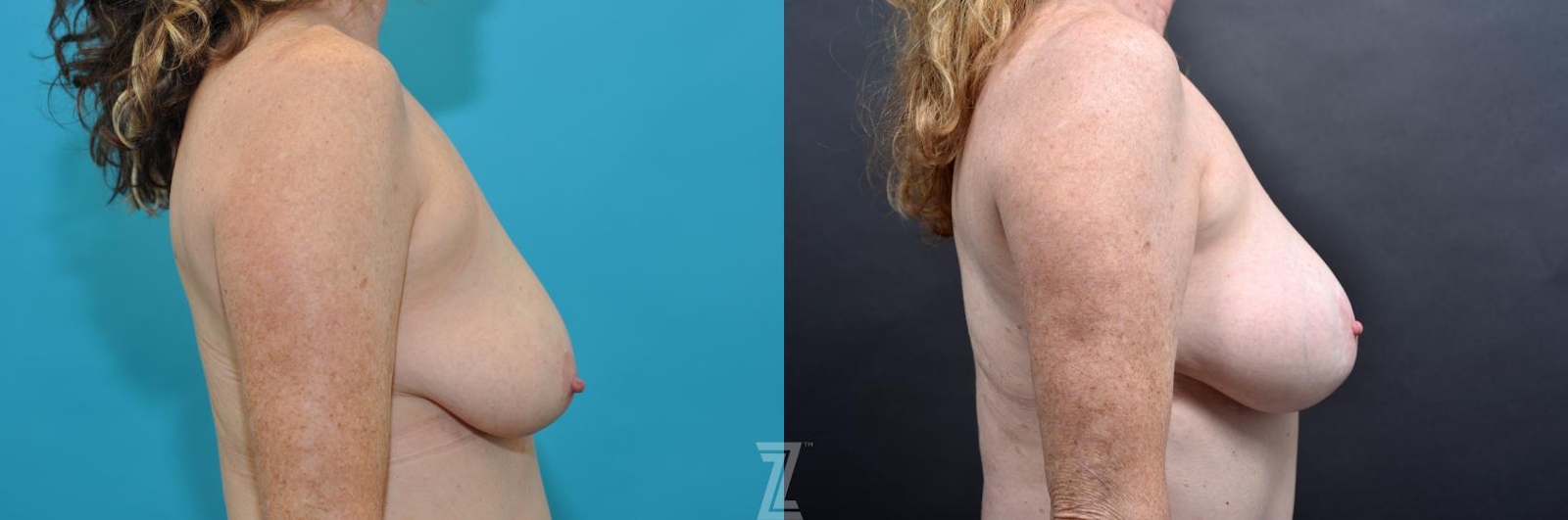 Austin Lateral breast view 7 year post op mommy makeover - The Piazza Center, Austin Tx - The Piazza Center