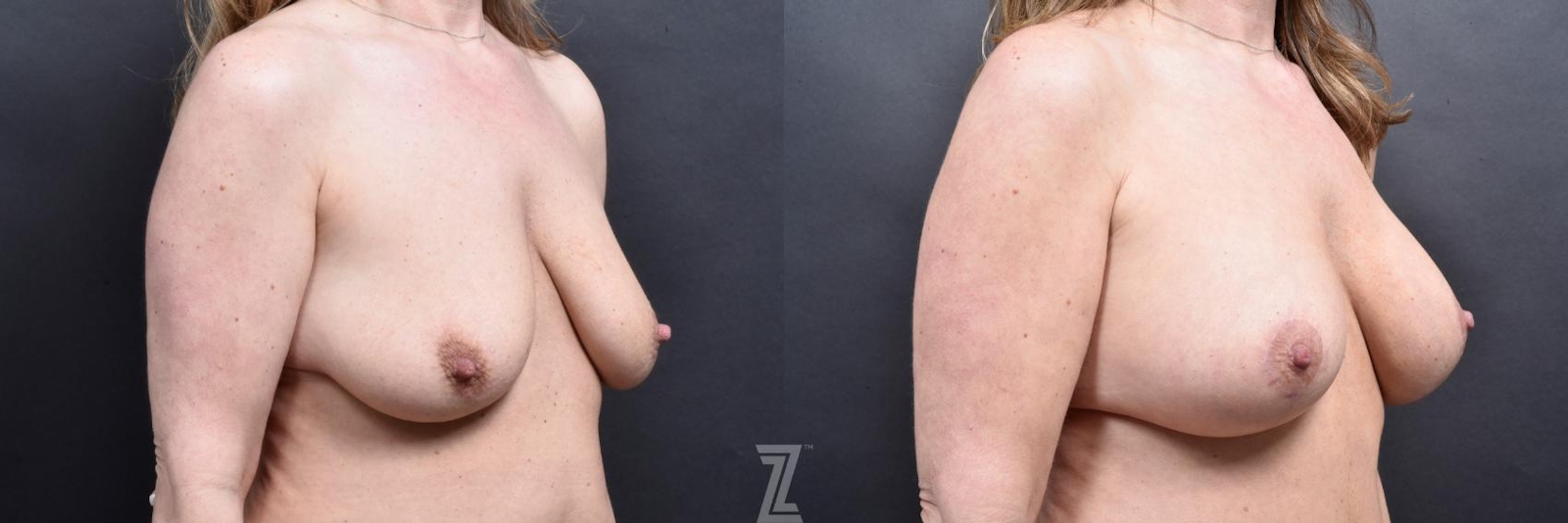 Austin Breast of 41-Year-Old 7 month post op Mommy Makeover Before & After Oblqiue view by Dr. Rocco Piazza in Austin, Texas - The Piazza Center