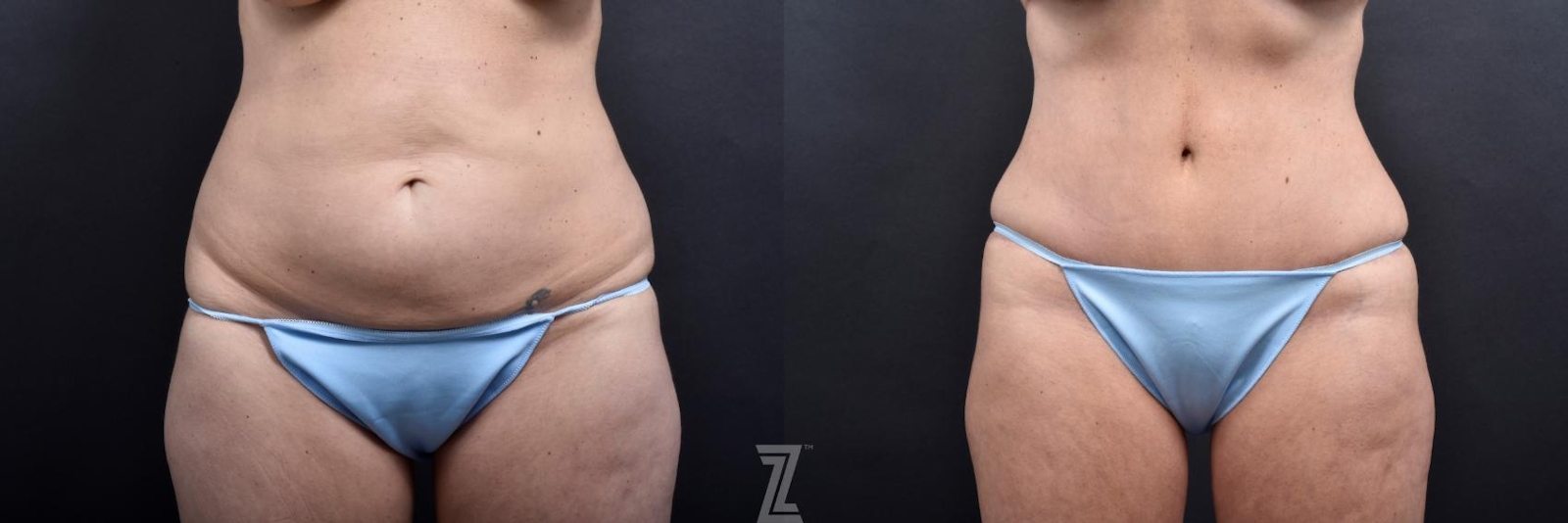 Austin Frontal Abdomen View from Mommy Makeover of 41 year old woman in Austin, TX by Dr. Rocco Piazza - Before & After - The Piazza Center