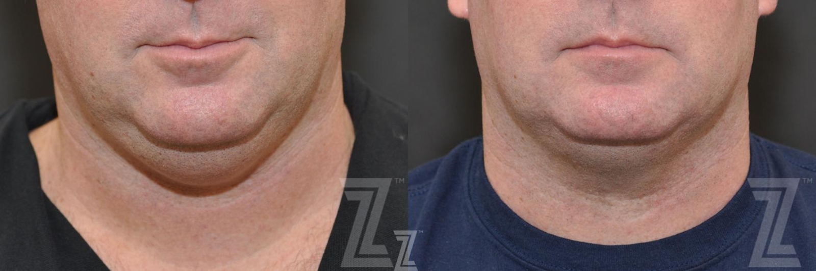 Austin CoolSculpting® Before & After Gallery - Patient 132905380 - Image 1 - The Piazza Center