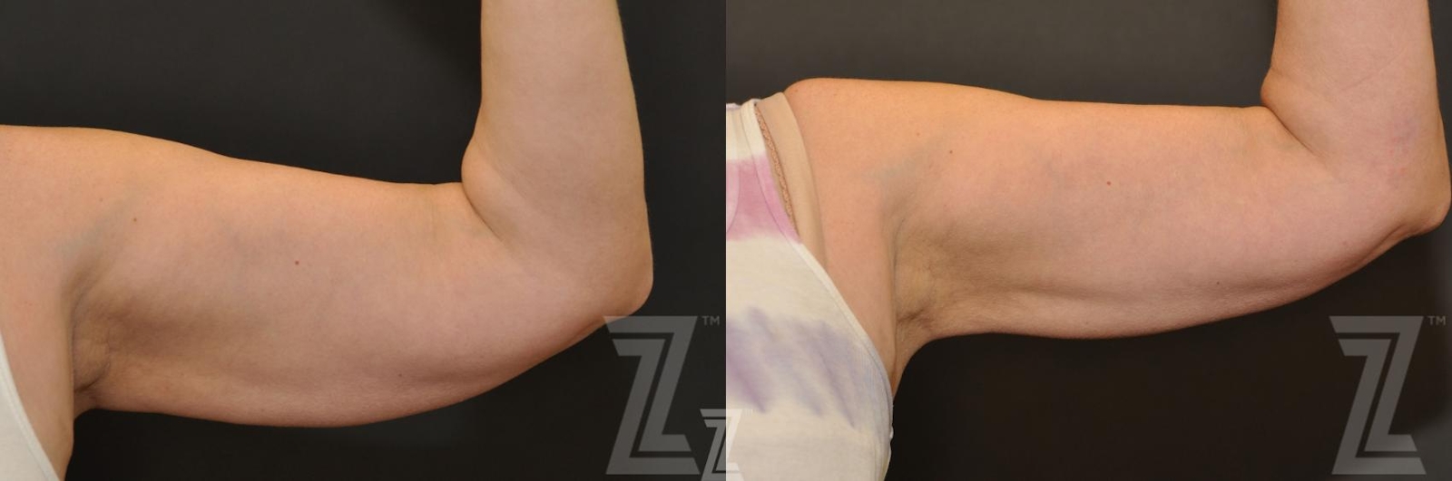 Austin CoolSculpting® Before & After Gallery - Patient 132905381 - Image 1 - The Piazza Center