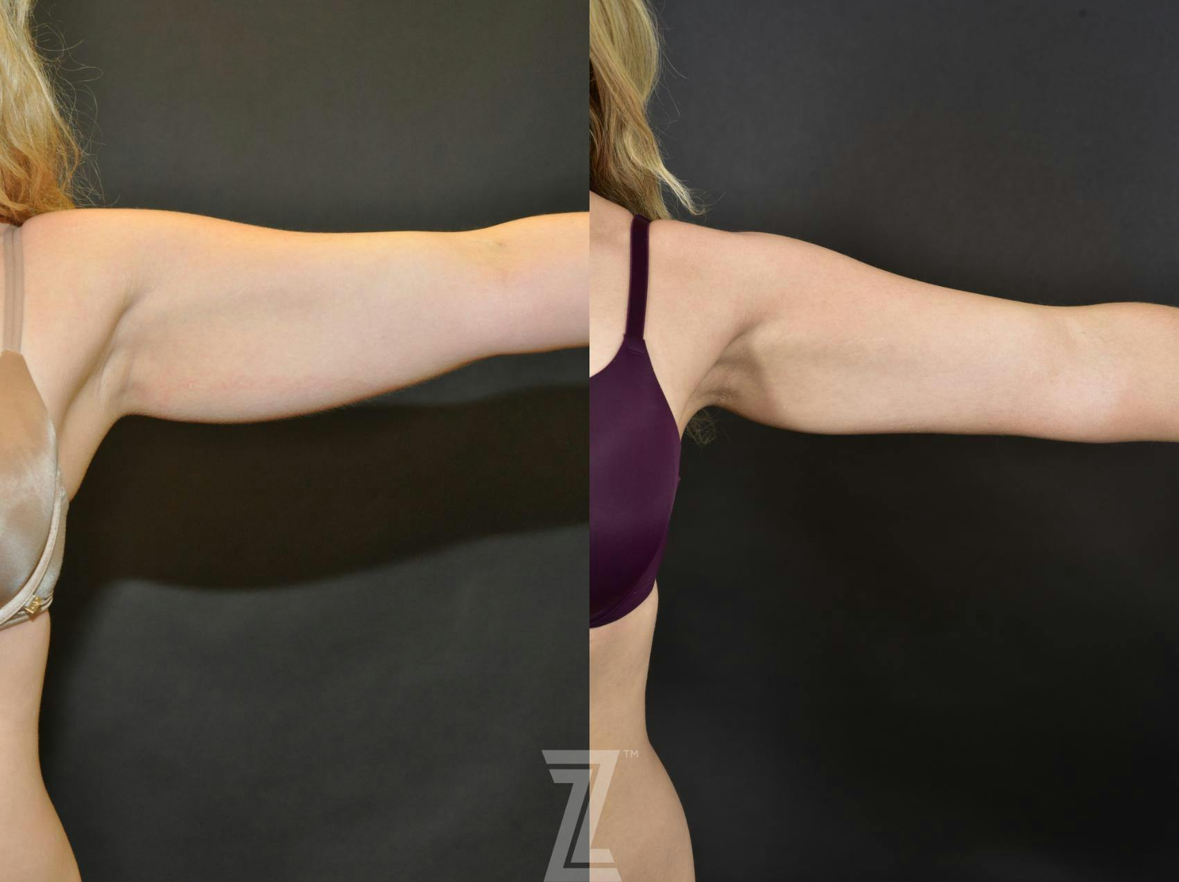 CoolSculpting® Before & After Gallery - Patient 132905382 - Image 1