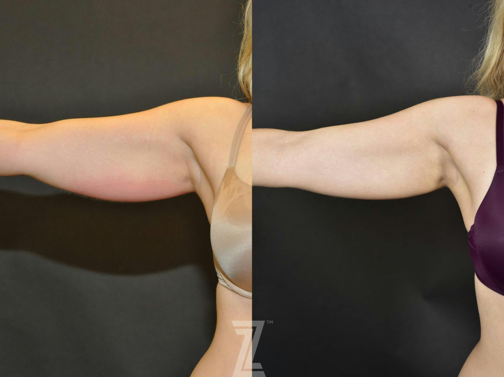 CoolSculpting® Before & After Gallery - Patient 132905382 - Image 2