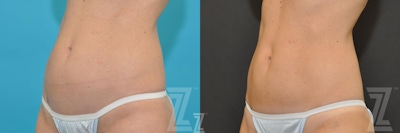 CoolSculpting® Before & After Gallery - Patient 132905384 - Image 1