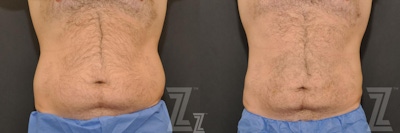 CoolSculpting® Before & After Gallery - Patient 132905386 - Image 1