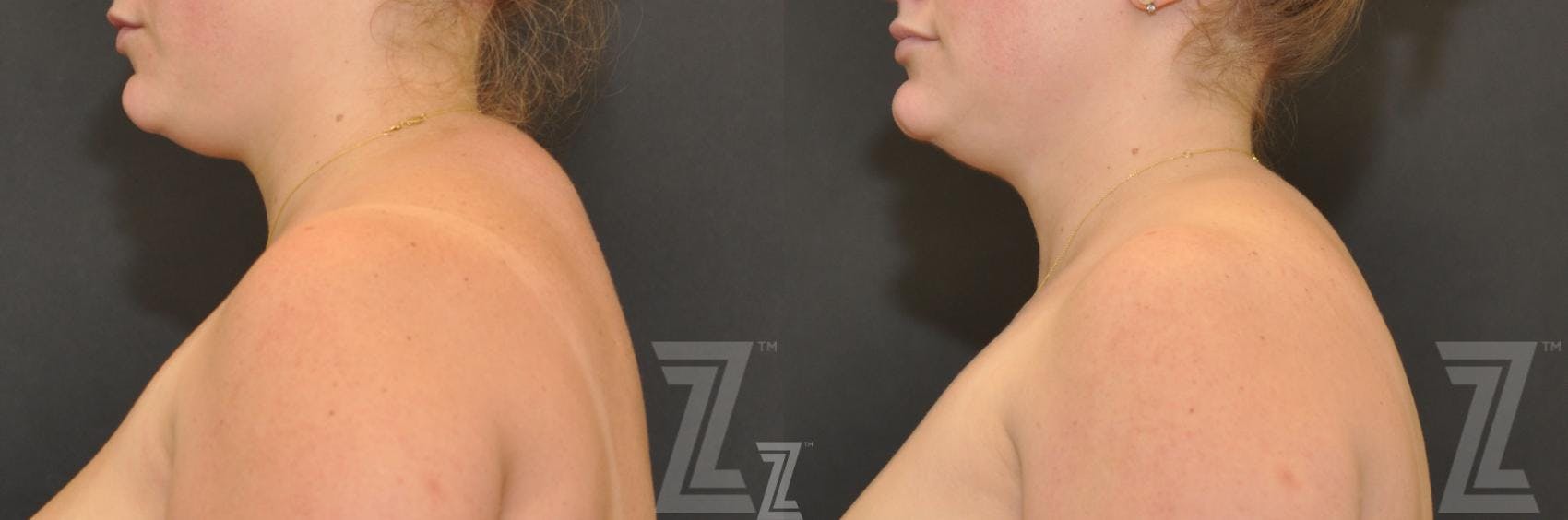 CoolSculpting® Before & After Gallery - Patient 132905387 - Image 1