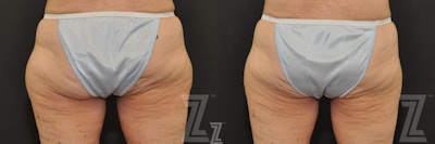 CoolSculpting® Before & After Gallery - Patient 132905389 - Image 1