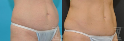CoolSculpting® Before & After Gallery - Patient 132905390 - Image 1