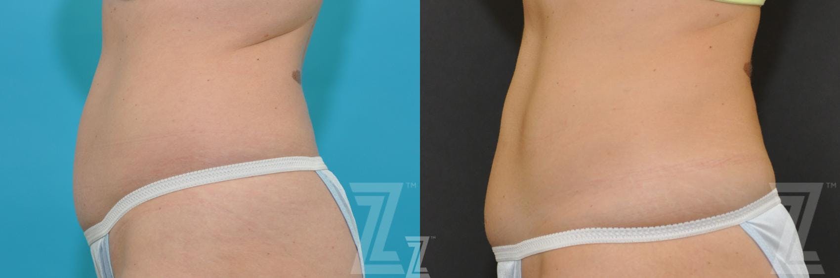 CoolSculpting® Before & After Gallery - Patient 132905390 - Image 2
