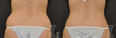 CoolSculpting® Before & After Gallery - Patient 132905391 - Image 1