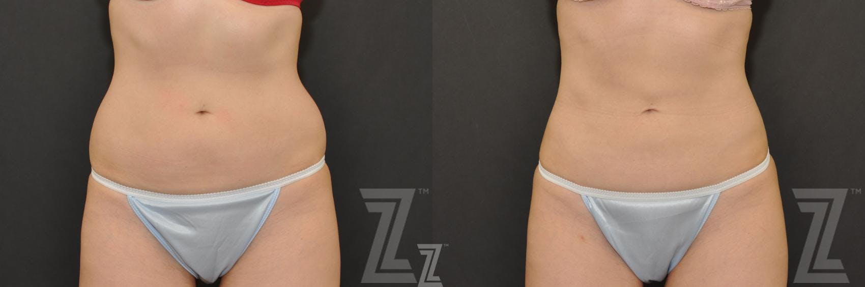 CoolSculpting® Before & After Gallery - Patient 132905391 - Image 2