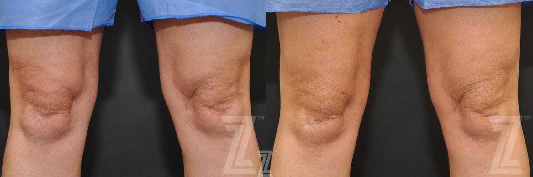 CoolSculpting® Before & After Gallery - Patient 132905392 - Image 1