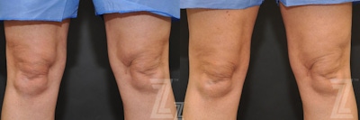 CoolSculpting® Before & After Gallery - Patient 132905392 - Image 1